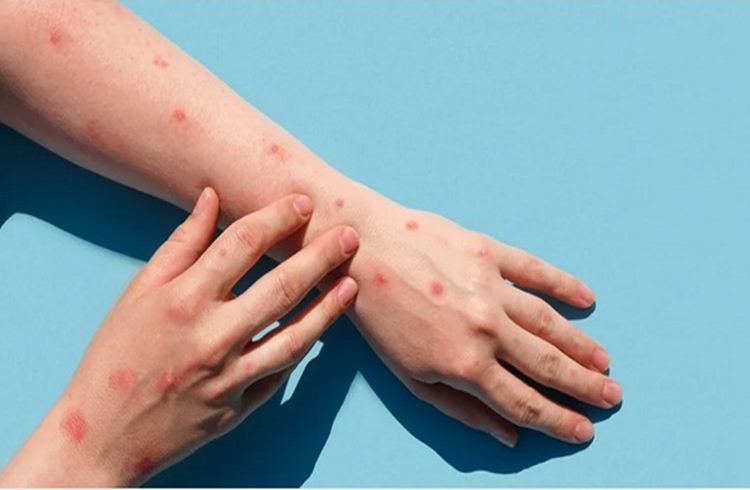 Muriaé registra primeiro caso suspeito de varíola dos macacos