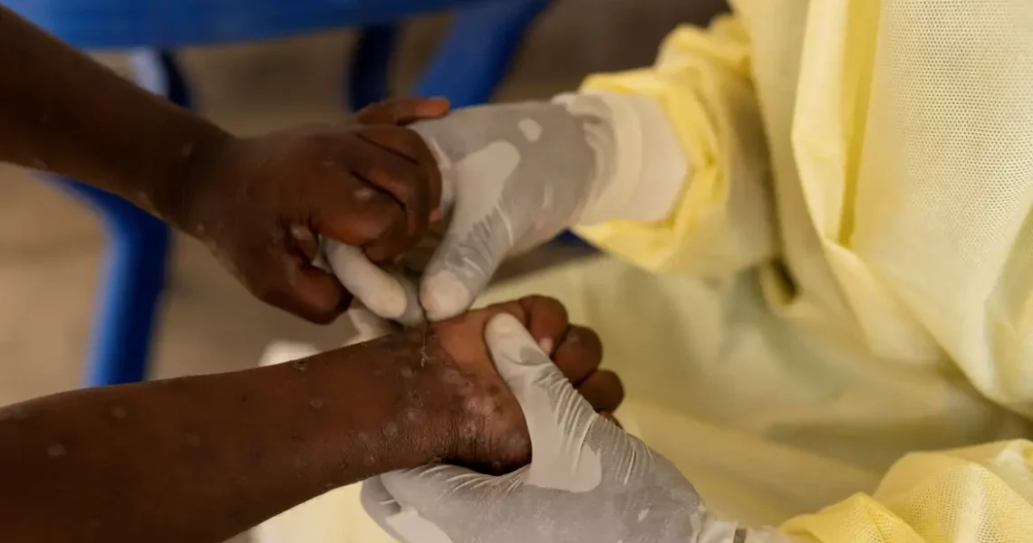 Mpox: conheça sintomas e tire principais dúvidas sobre a doença