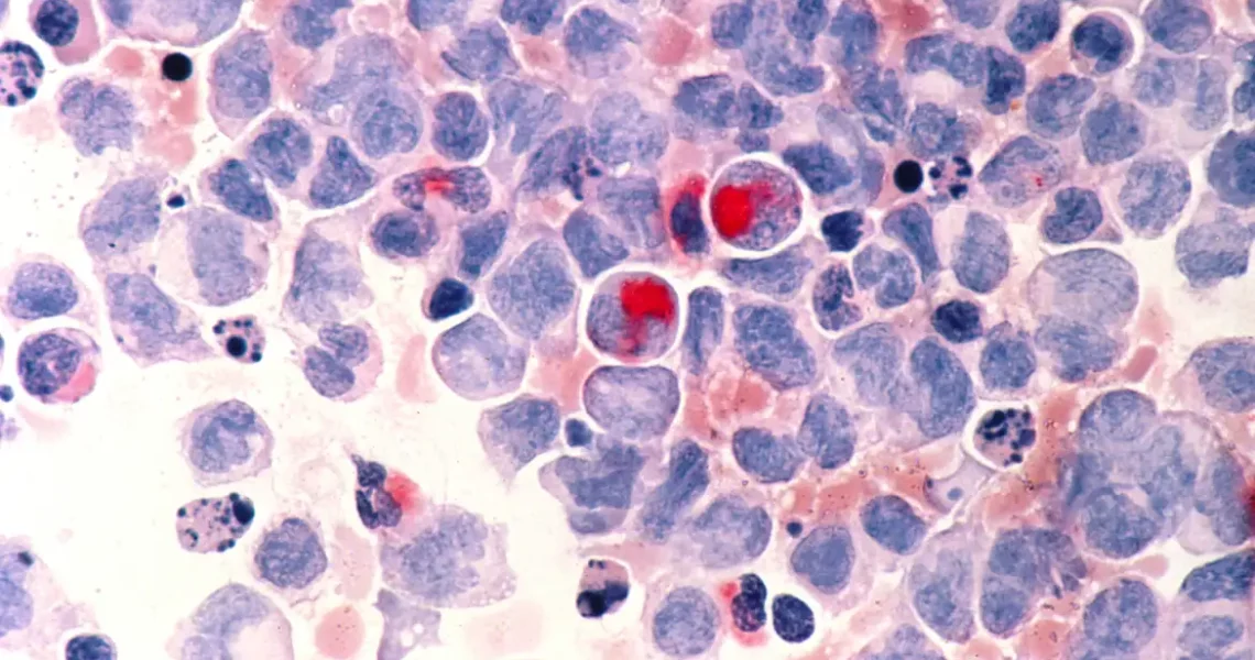 Planos de saúde vão ter que garantir novo medicamento para leucemia