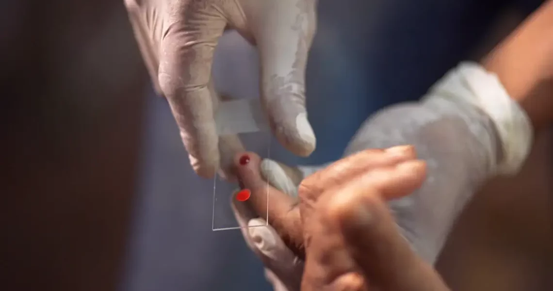 SUS começa a usar novo tratamento contra a malária em crianças